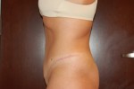 Tummy Tuck