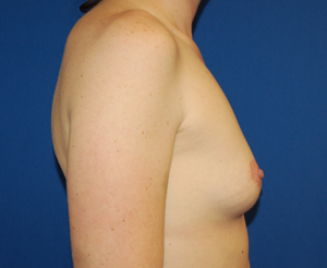 Breast Augmentation Case 1997 Before Photo Breast Augmentation