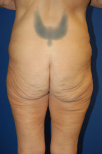 Body Lift Result Plano