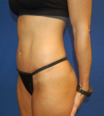 Tummy Tuck