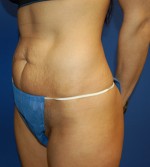 Tummy Tuck