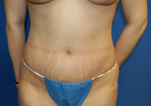 Tummy Tuck