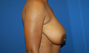 Breast Reduction Case 3196 Before Photo Breast Reduction