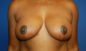 Breast Reduction