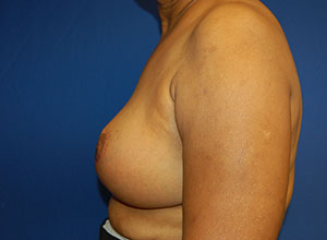 Breast Reduction Case 3202 After Photo Breast Reduction