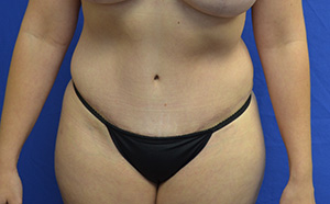 Tummy Tuck