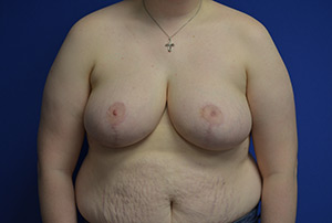 Breast Reduction