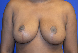 Breast Reduction Case 3287 After Photo Breast Reduction