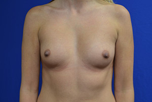 Breast Augmentation