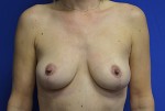 Breast Lift