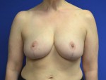 Breast Reduction