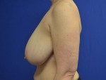 Breast Reduction