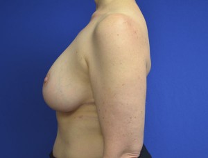 Breast Reduction