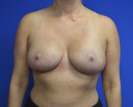 Breast Reduction