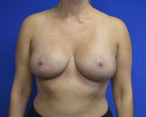 Breast Reduction