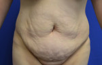 Tummy Tuck