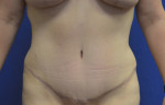 Tummy Tuck