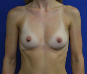 Breast Augmentation Result Plano