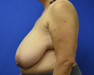 Breast Reduction