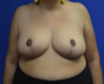 Breast Reduction