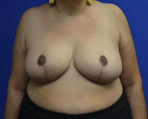 Breast Reduction