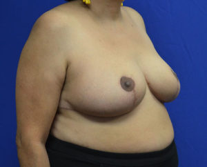 Breast Reduction