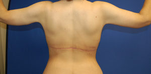 Body Lift Case 3464 After Photo Body Lift